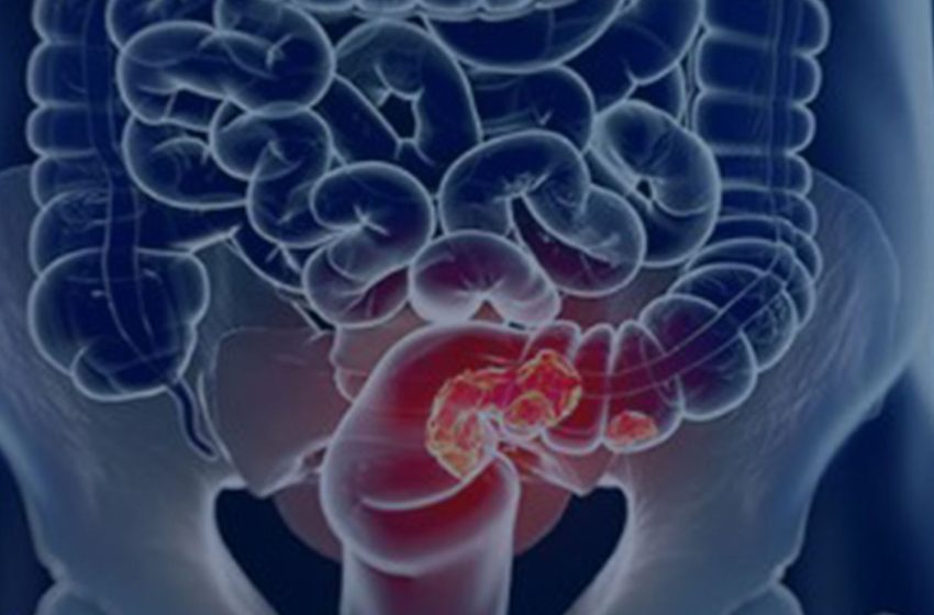  Março azul: a luta silenciosa contra o câncer colorretal